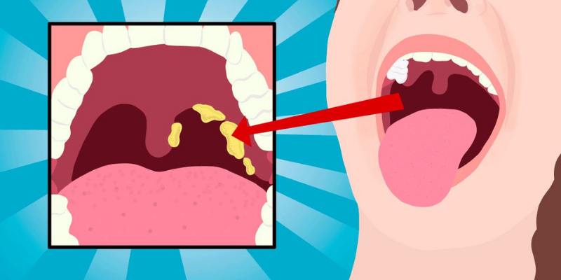 How to Treat Tonsil Stones at Home