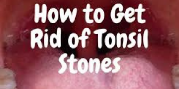 Tonsil Stones treatments